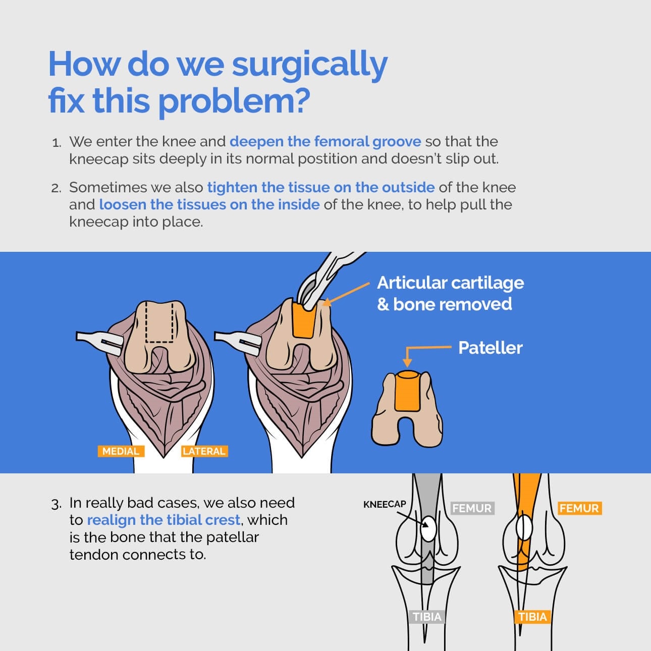 MPL surgery Concept Diagram