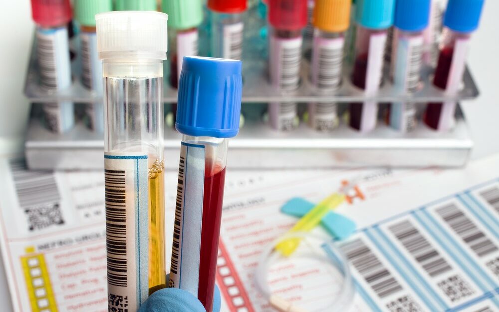 blood testing close up of vials