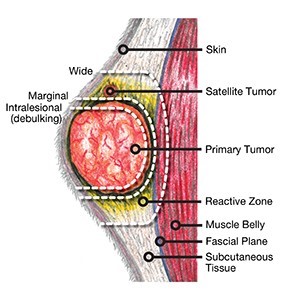 cancer surgery tumor lump