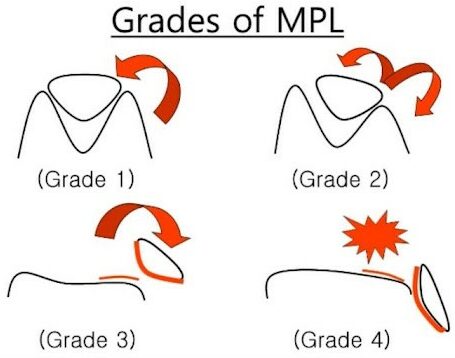 grades of MPL