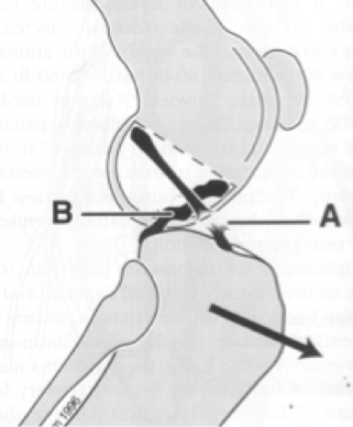 torn ACL diagram