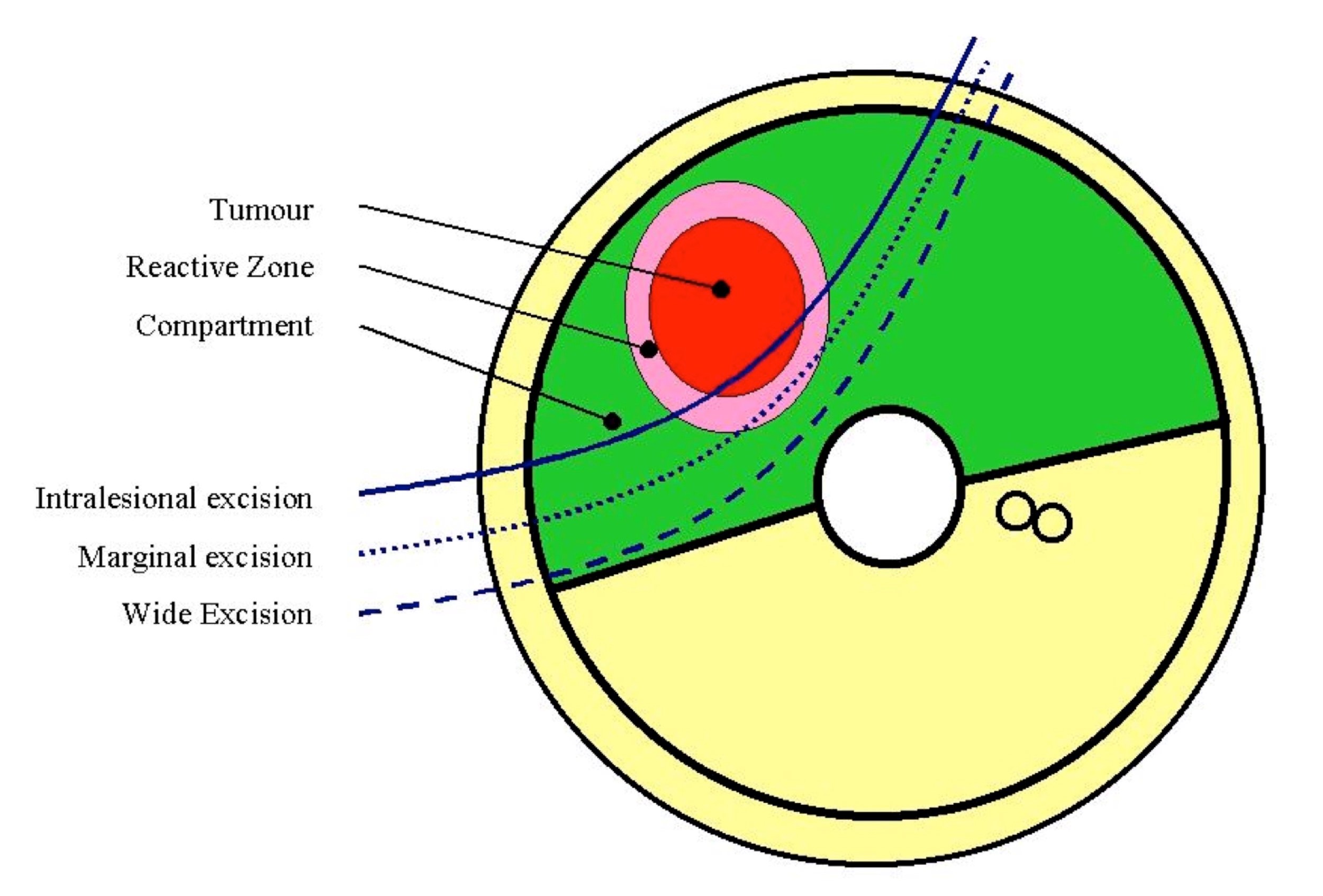 tumour diagram